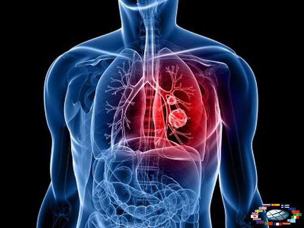 Симптомы рака легких у женщин